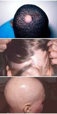 alopeciaareaa alopeciaareaa