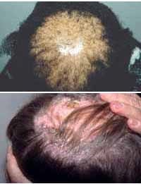 cicatricialalopecia cicatricialalopecia