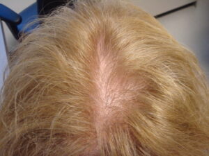Female pattern hair loss - American Hair Research Society