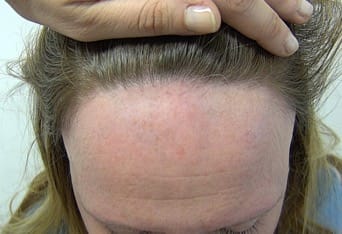 Cicatricial Alopecia